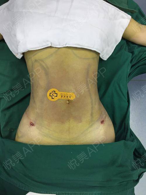 {足球投注}(腰腹吸脂20天感觉就和没抽一样) {足球投注}(腰腹吸脂20天感觉就和没抽一样)